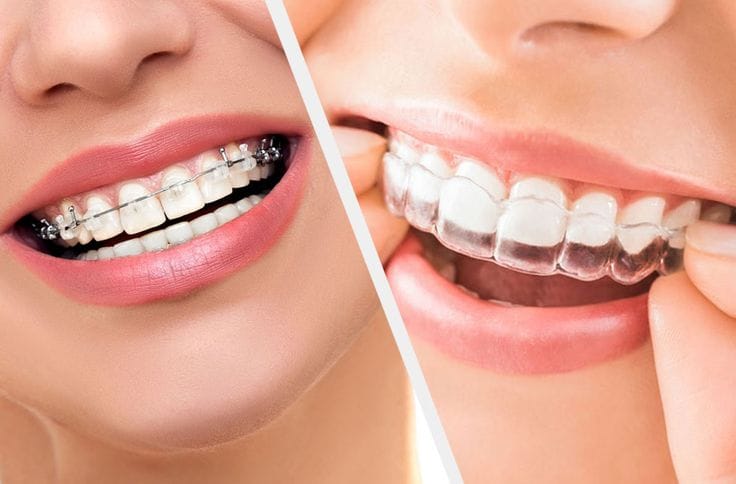 Braces and Invisalign Services in Addis Ababa