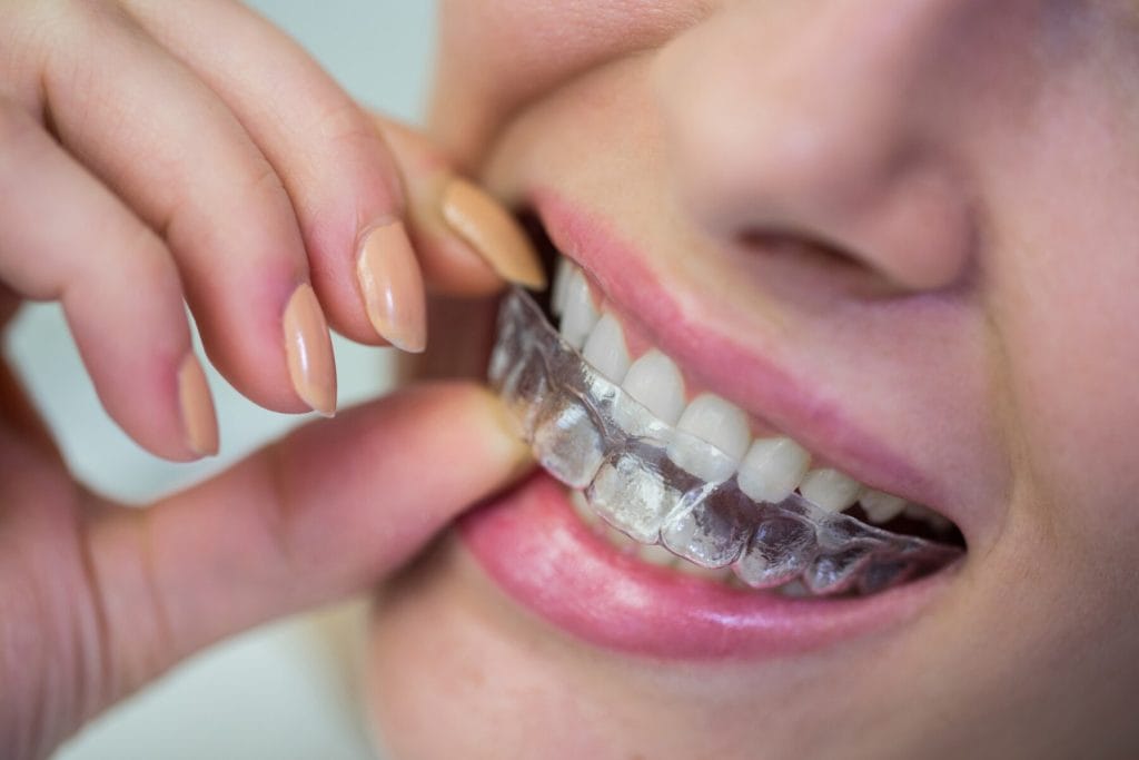 Invisalign Service in Addis Ababa