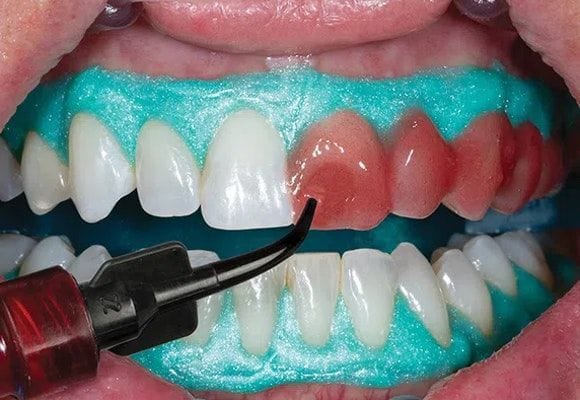 tooth whitening service in Addis Ababa