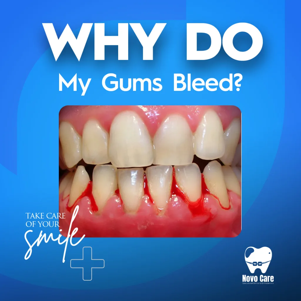 Why Do My Gums Bleed