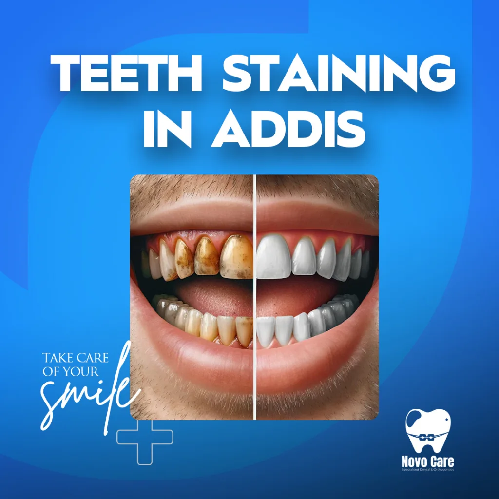 Teeth Staining in Addis