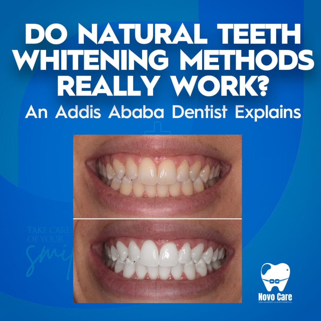 Do Natural Teeth Whitening Methods Really Work