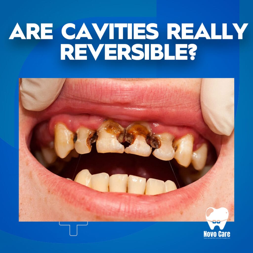Are Cavities Really Reversible