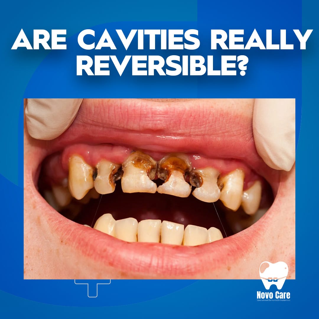 Are Cavities Really Reversible? NovoCare Explains the Truth1