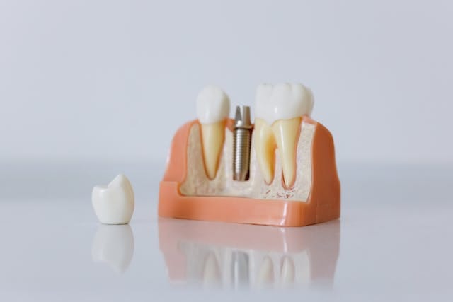 Single Tooth Implant In Addis Ababa
