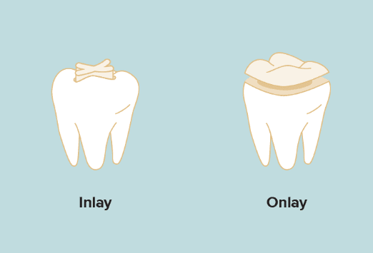 Dental inlays vs onlays _Novo Care