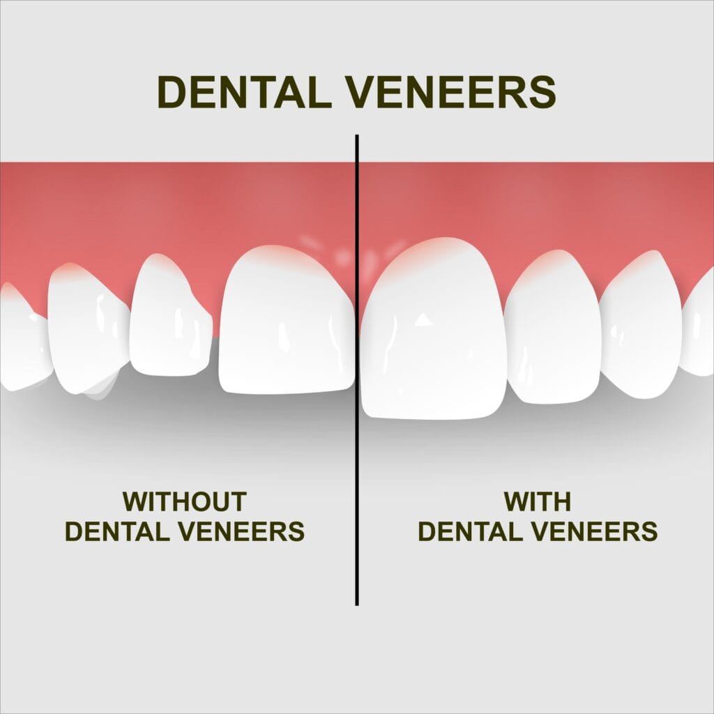 Porcelain Veneers in Addis Ababa_Novo care